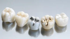 Zahnfüllungen: Welche Materialien gibt es und welches Material passt?